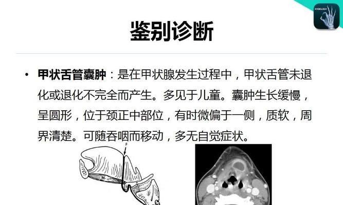 腮裂囊肿手术后多久可以恢复游泳？